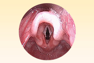 Ангионевротический отек гортани Ангионевротический отек