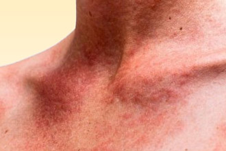 Мелкая зудящая сыпь Сыпь