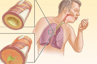 Бронхиальная астма - один из предрасполагающих факторов Бронхиальная астма