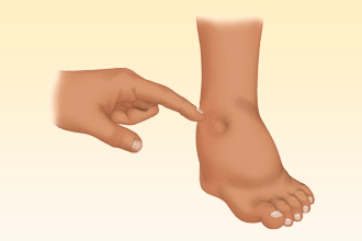 Аллергия часто проявляется в виде отека Отек