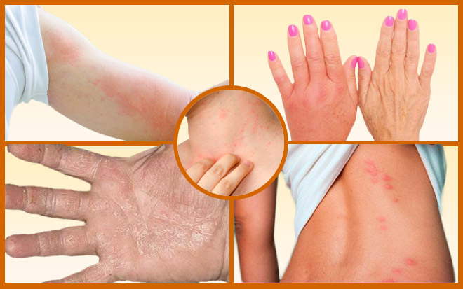 Дерматологические проявления аллергии на цветение одуванчика Дерматологические проявления