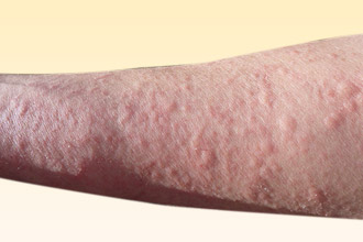 Крапивница может быть связана с прямым контактом с пыльцой Крапивница