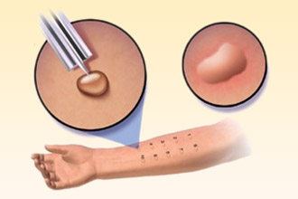 Кожные пробы - золотой стандарт диагностики Кожные пробы