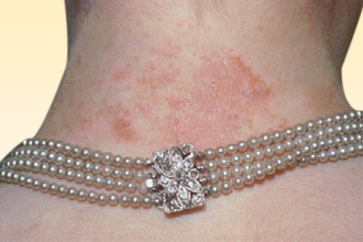 Аллергия на серебро