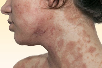 Проявление аллергической реакции на коже Дерматит