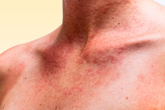 Кожные проявления фотодерматоза Фотодерматоз