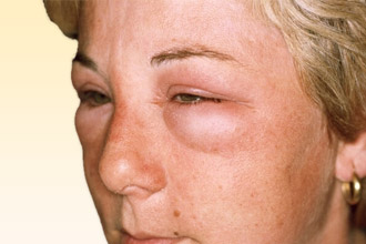 Отек Квинке представляет опасность для жизни Отек Квинке