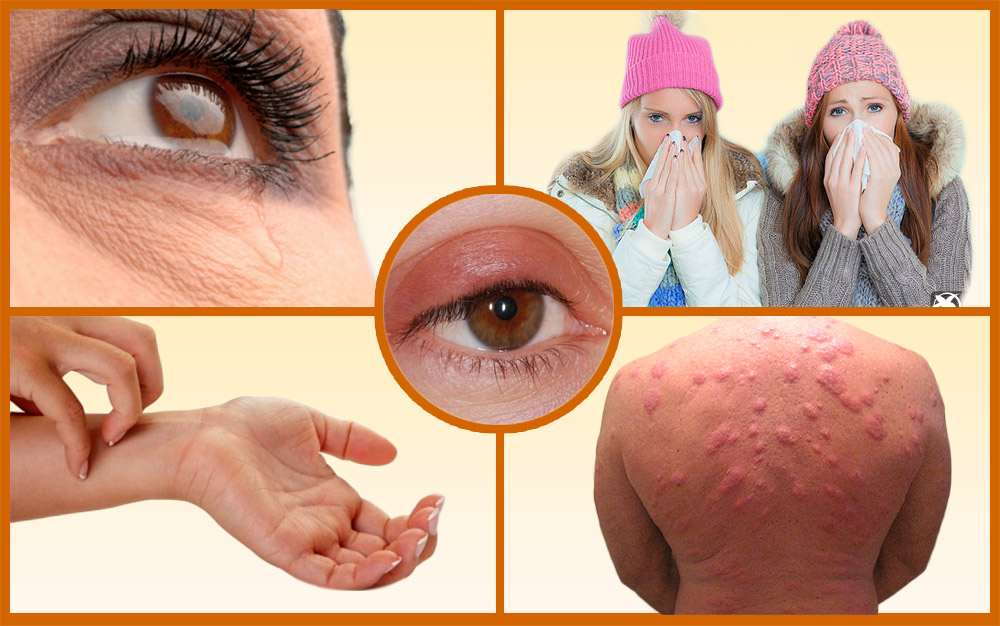 Признаки холодовой крапивницы Симптомы