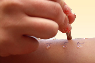 Диагноз устанавливают с помощью кожных проб Кожные пробы