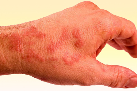 Раздражение от мыла на руках Аллергия на руках