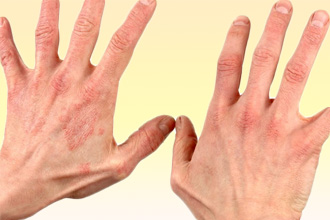 Контактный дерматит Контактный дерматит