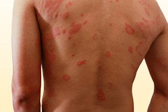 Атопический дерматит