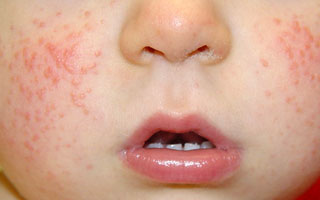 Атипичный дерматит у ребенка Атипичный дерматит