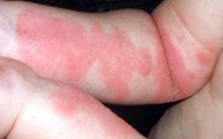 Кожные высыпания Симптомы болезни