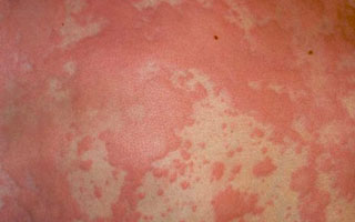 Обострение патологии Симптомы дерматита