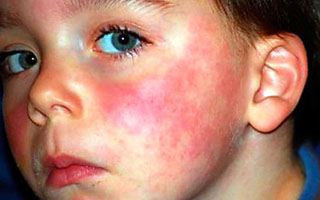 Атопическая кожа Атопический дерматит