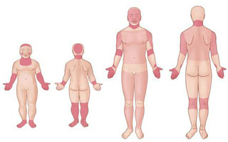 Локализация атопического дерматита Признаки болезни