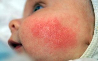 Младенческая фаза болезни Стадии развития болезни