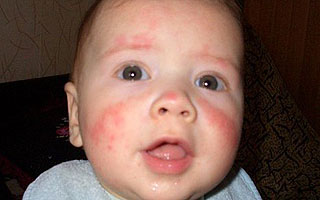 Аллергия у грудничка на белок коровьего молока Аллергия у грудничка