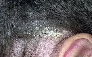 Себорейный дерматит Показания