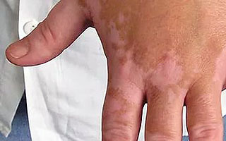 Белые пятна на коже Побочные эффекты