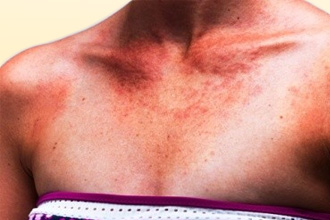 Крапивница Крапивница