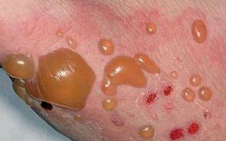 Проявление буллезного дерматита Буллезный дерматит