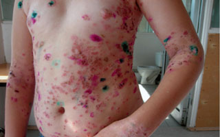 Применяем раствор "Фукорцин" Лечение болезни