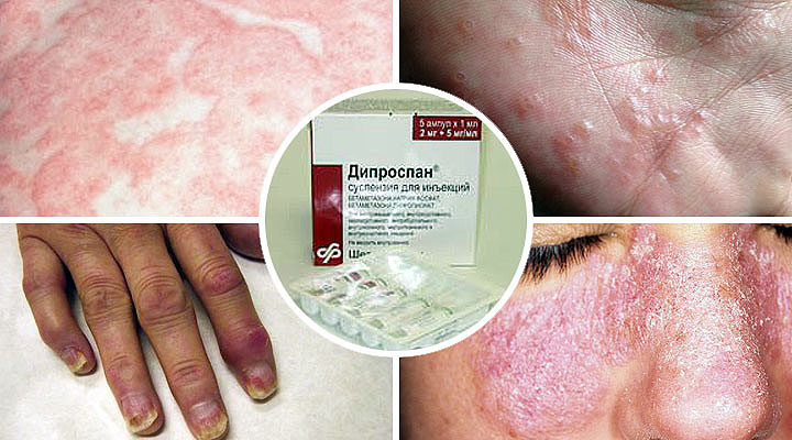 Примеры заболеваний, при которых используют препарат Показания