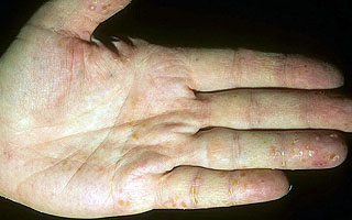 Дисгидроз ладоней Дисгидроз ладоней