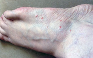 Дисгидроз ног на начальной стадии Дисгидроз ног