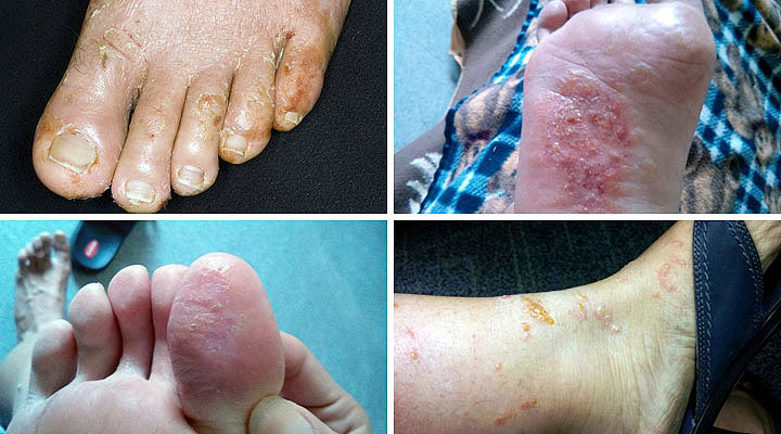 Проявления болезни на разных стадиях Проявления болезни