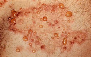 Герпетиформный дерматит Дюринга Герпетиформный дерматит Дюринга