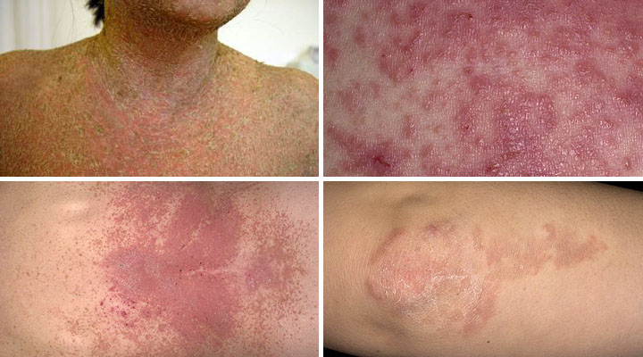 Проявления герпетиформного дерматита Дюринга Клинические проявления