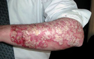Экссудативный псориаз на руке Экссудативный псориаз