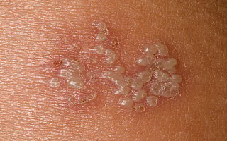 Проявления герпетического везикулярного дерматита Герпетический везикулярный дерматит