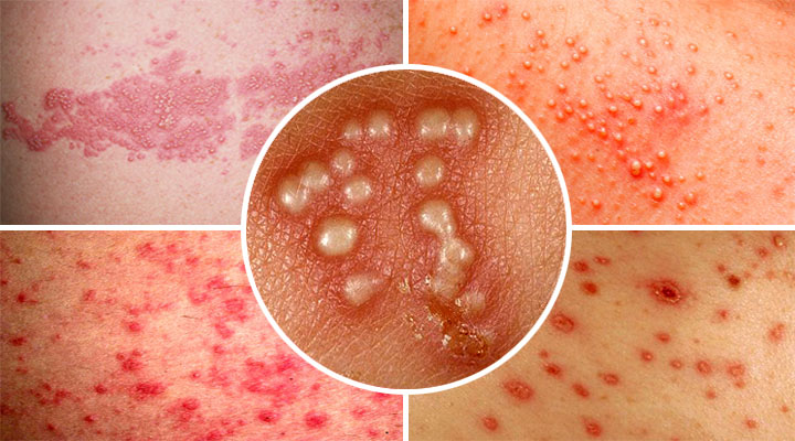 Различные стадии болезни Симптомы болезни