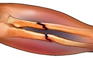 Перелом костей Показания