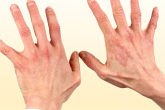 Холодовой дерматит Холодовой дерматит