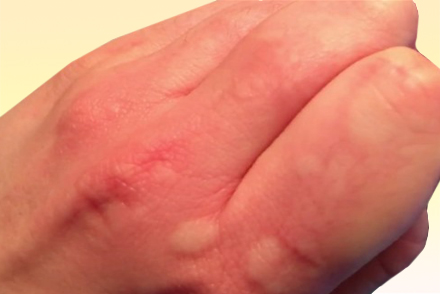 Холодовая аллергия 