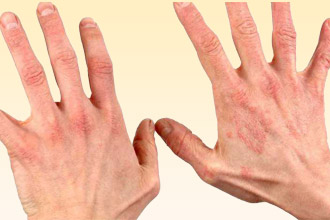 Дерматологические признаки аллергии Сыпь на руках