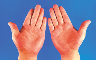 Инфекционный дерматит на руках Инфекционный дерматит