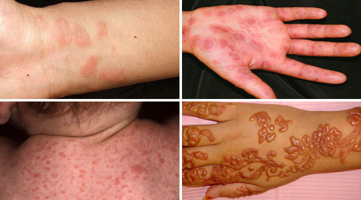 Проявления инфекционного дерматита Клинические проявления