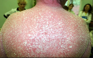 Прогрессирующая стадия псориаза распространённого Псориаз распространённый