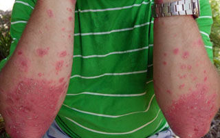 Симметричность расположения высыпаний Локальный статус