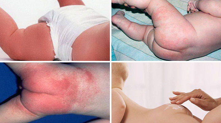Симптомы и лечение заболевания Фото кандидозного дерматита
