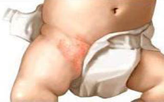 Пеленочный кандидозный дерматит Проявление болезни