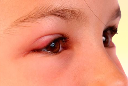 Конъюнктивит - признак аллергии Припухлость глаз