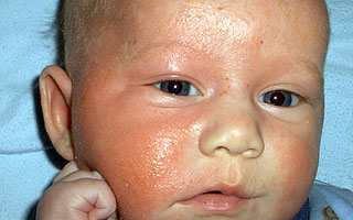 Аллергия на коровье молоко у ребёнка Аллергия на коровье и козье молоко