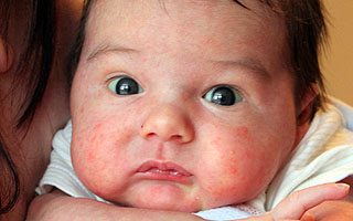 Сыпь у ребенка Дерматологические проявления